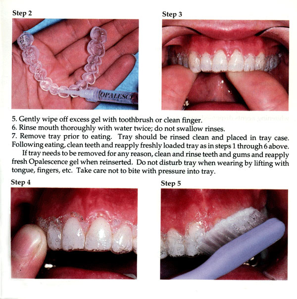 tips using teeth whitening trays